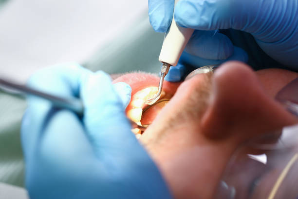 Best Broken or Chipped Tooth Repair in Leon, IA